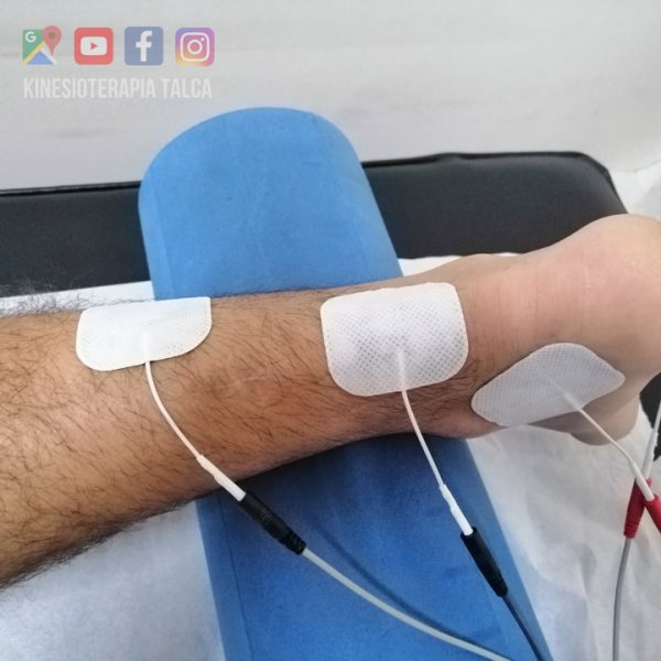 Tendinitis Talca