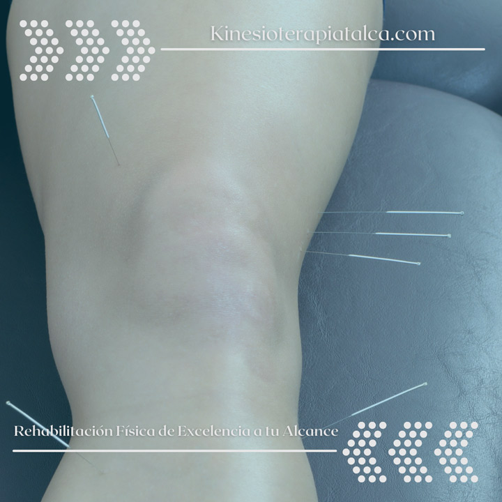 Artrosis de rodilla – Fisioterapia a tu alcance