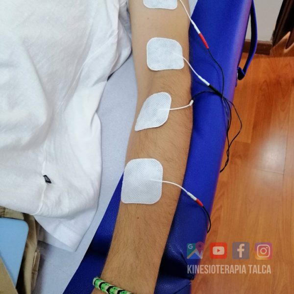 Tendinitis Talca