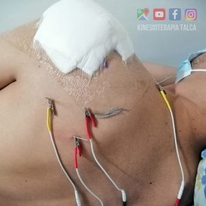 KINESIOLOGOS-MAS-RECOMENDADOS-DE-FONASA-EN-TALCA-FRACTURAS